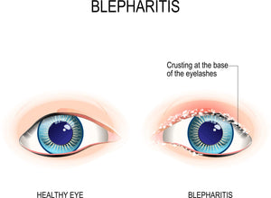Difference between Dry Eyes, Blepharitis and MGD - Get Solutions