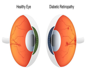 Diabetes and Eye Care