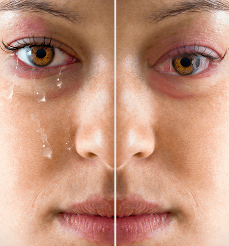 Difference between Dry Eyes or Tear Dysfunction Syndrome?